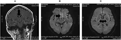 A Case Report of Wernicke's Encephalopathy Associated With Schizophrenia